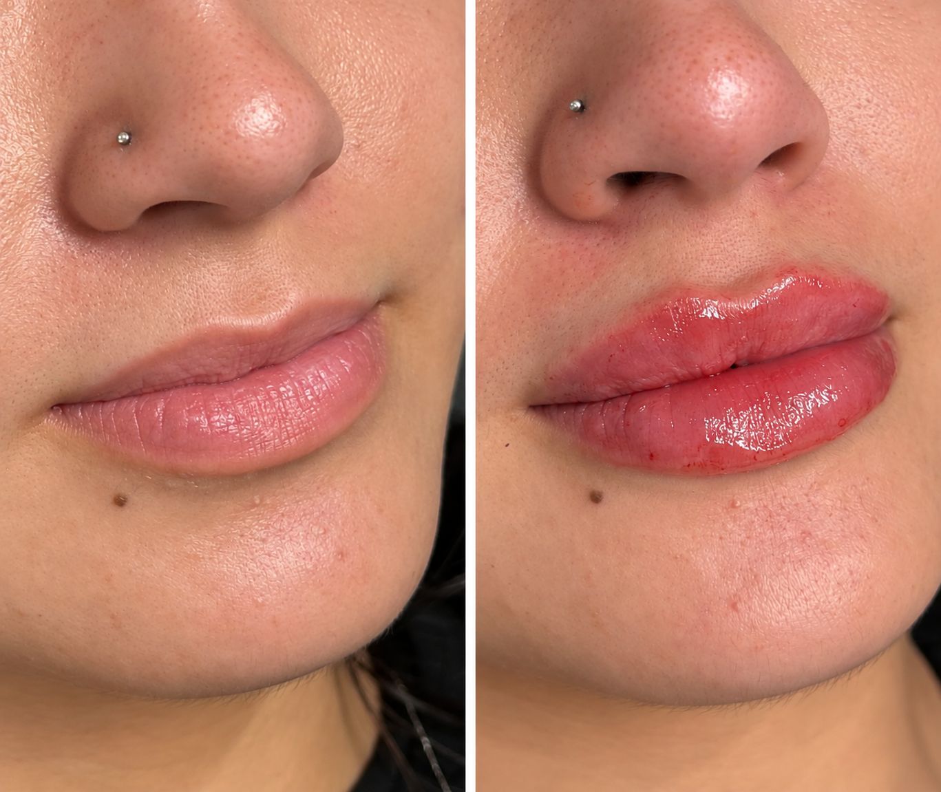 Before and after lip filler results